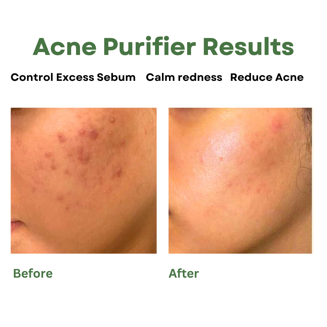 Acne Purifier Face Gel for Pimples
