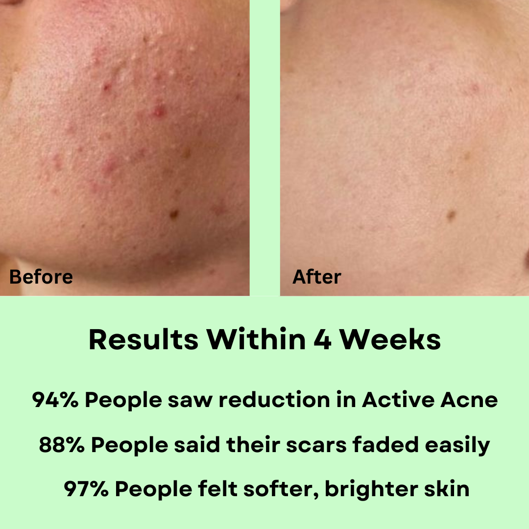 Acne Reduction Combo for oily skin (Pack of 3) - M&U Skin and Beauty