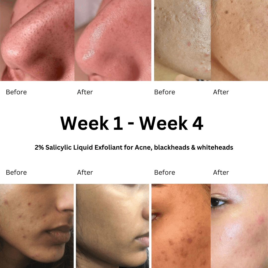 Pore Purifier 2% Salicylic Acid Toner to Unclog Pores - M&U Skin and Beauty