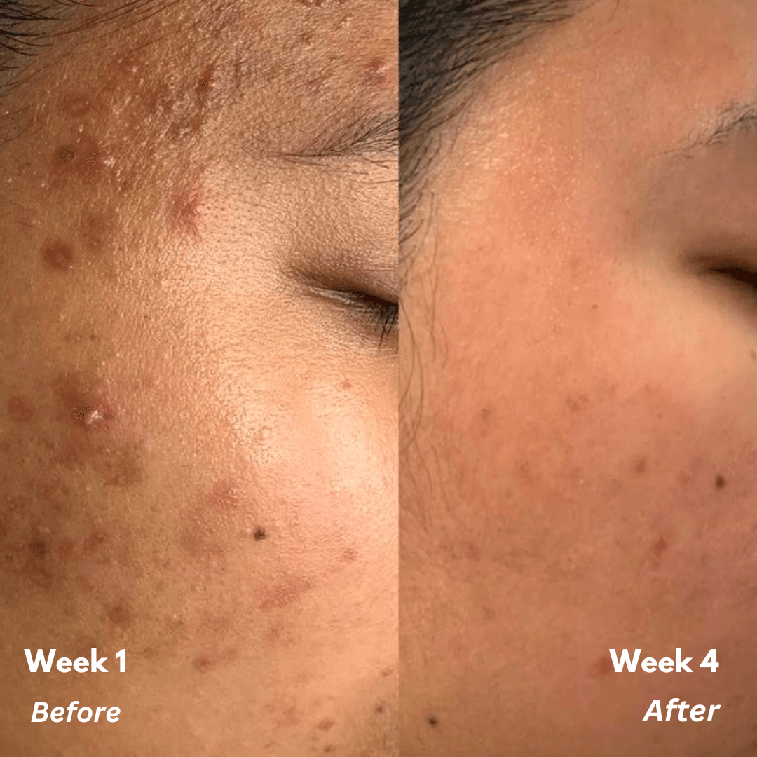 Pore Purifier 2% Salicylic Acid Toner to Unclog Pores - M&U Skin and Beauty